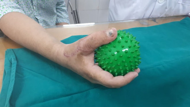 Chuyển ngón chân thành ngón tay cho thanh niên 17 tuổi - 2