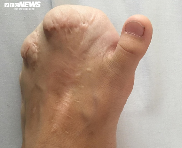 Xót xa nhìn đôi bàn chân bé gái mất 9 ngón sau 18 lần phẫu thuật - 2