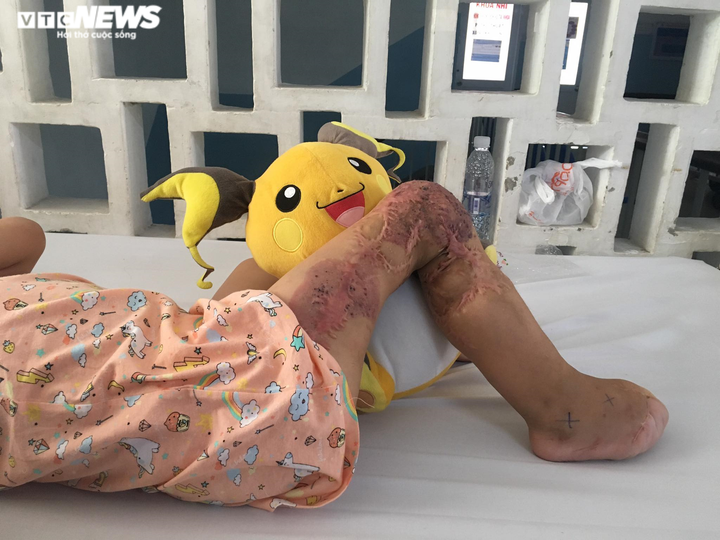 Xót xa nhìn đôi bàn chân bé gái mất 9 ngón sau 18 lần phẫu thuật - 3