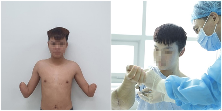 Kỳ tích y khoa Việt: Cùng lúc ghép 2 tay cho thanh niên 18 tuổi - 1