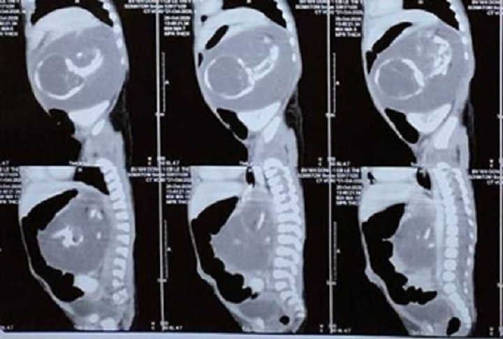 Lấy thành công bào thai trong bụng em bé mới lọt lòng - 1