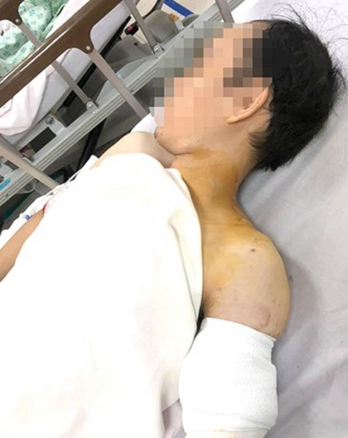 Nam thanh niên mang cối xay thịt 'nuốt' cánh tay đi cấp cứu - 2