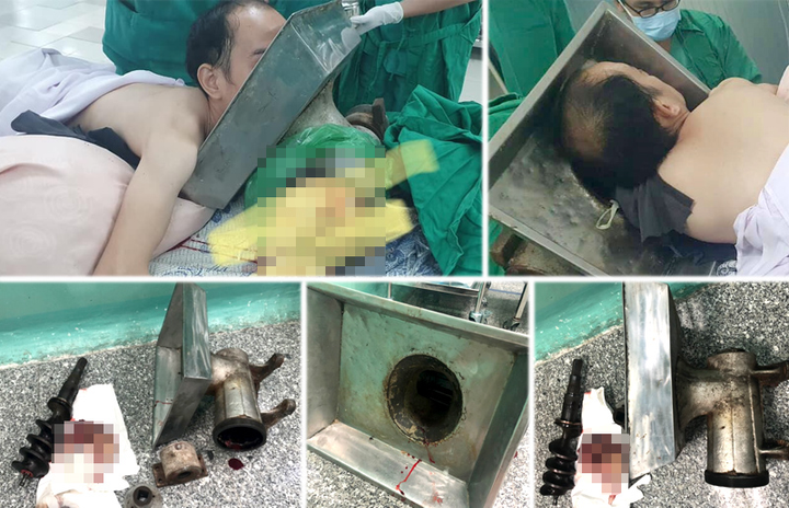 Nam thanh niên mang cối xay thịt 'nuốt' cánh tay đi cấp cứu - 1