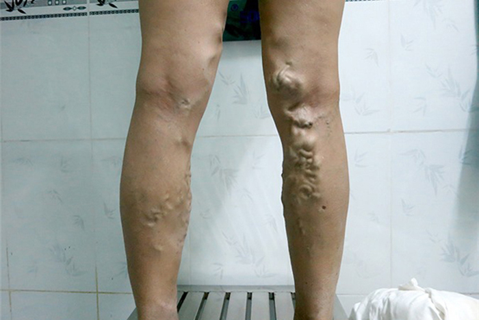 Đi giày cao gót, mặc váy bó: Cẩn thận giãn tĩnh mạch - 2