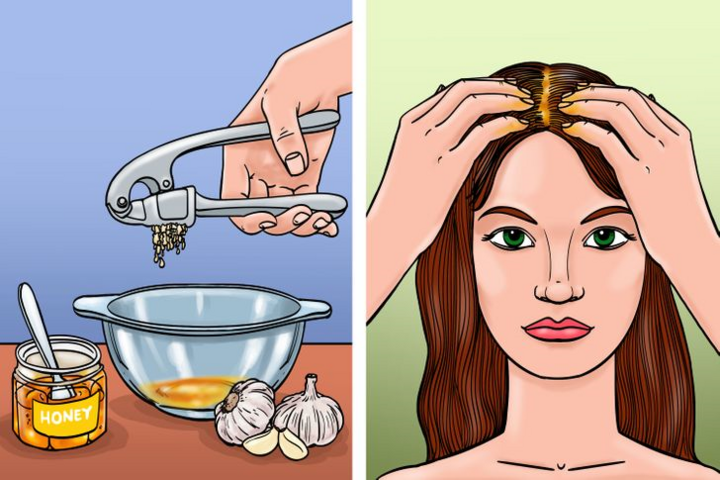 9 cách trị gàu cực tốt mà không cần dùng hóa chất - 9
