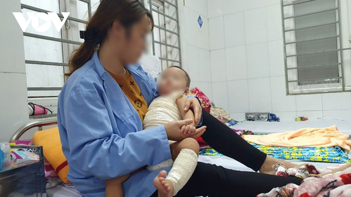 Chữa bỏng bằng thuốc lá, bé 13 tháng tuổi bị nhiễm trùng nặng - 1