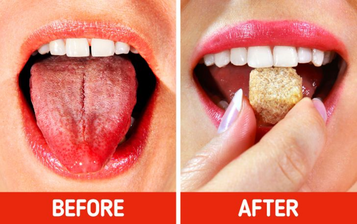Mẹo chữa bỏng lưỡi khi ăn uống phải món nóng - 6