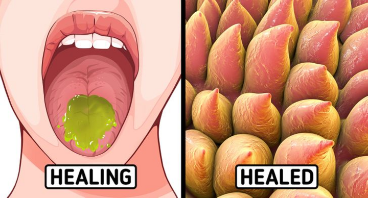 Mẹo chữa bỏng lưỡi khi ăn uống phải món nóng - 5