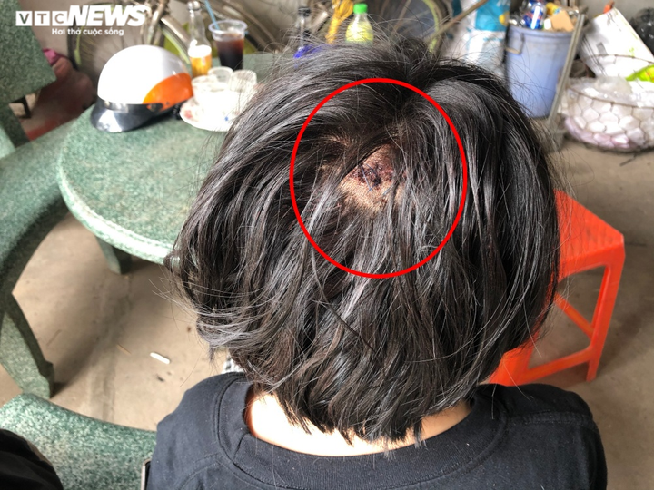 Nữ sinh bị tên côn đồ đạp liên tiếp vào mặt: 'Con sợ không ngủ được' - 2