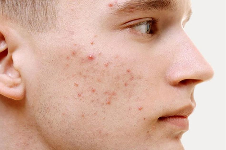 Hướng dẫn trị mụn đúng cách với khí hậu nóng ẩm và môi trường khói bụi Việt Nam - 1