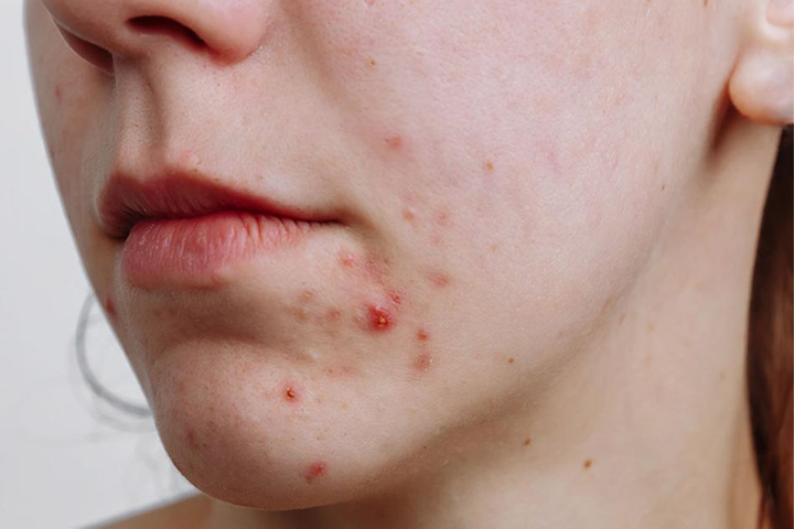 Hướng dẫn trị mụn đúng cách với khí hậu nóng ẩm và môi trường khói bụi Việt Nam - 2
