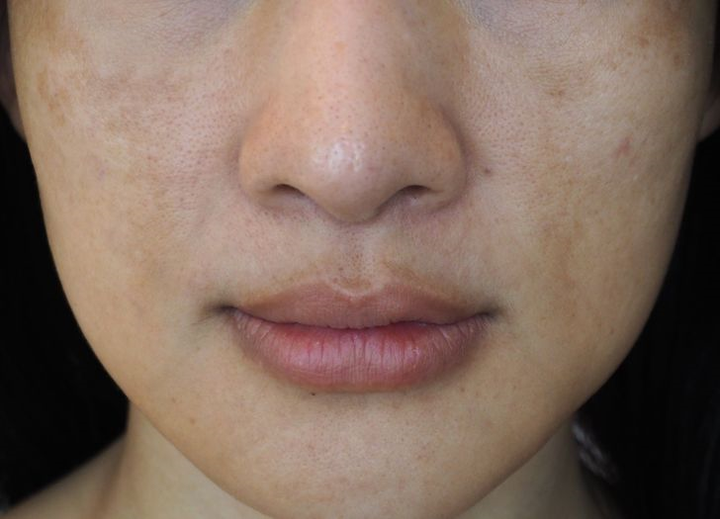 8 sai lầm khi chăm sóc da khiến lỗ chân lông ngày càng to - 4