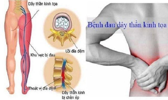 Tìm hiểu về căn bệnh đau thần kinh tọa - 3