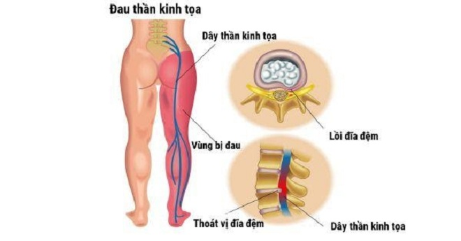 Tìm hiểu về căn bệnh đau thần kinh tọa - 1