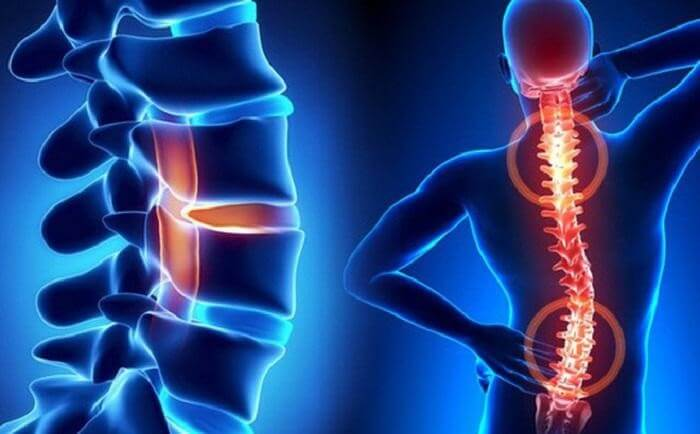 Những điều cần biết về bệnh thoái hóa cột sống - 1