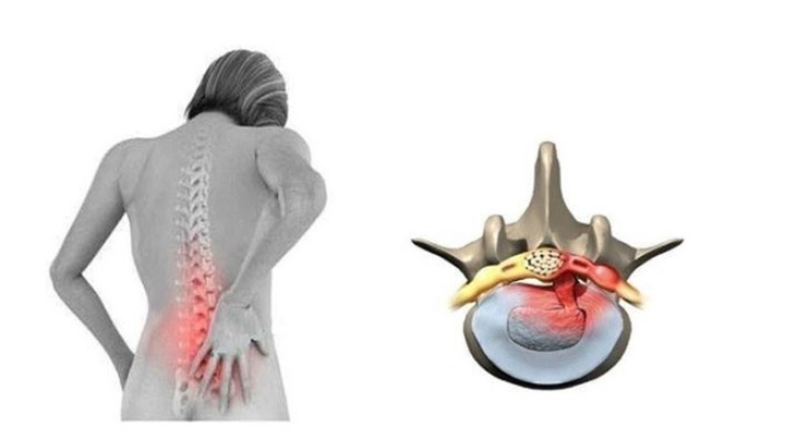 Thoát vị đĩa đệm thắt lưng: Triệu chứng, cách điều trị - 2
