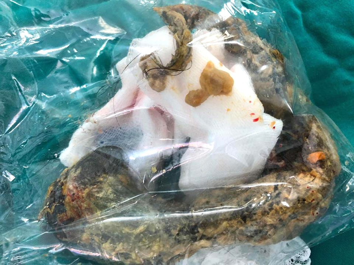 Bé gái 8 tuổi ở TP.HCM tắc ruột vì nghiện ăn tóc - 1