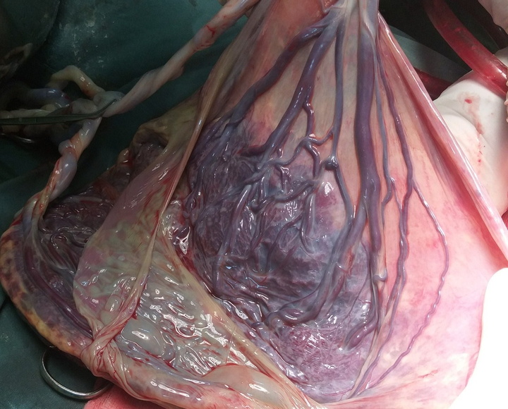 Dây rốn bám màng: Biến chứng thai kỳ nguy hiểm - 1