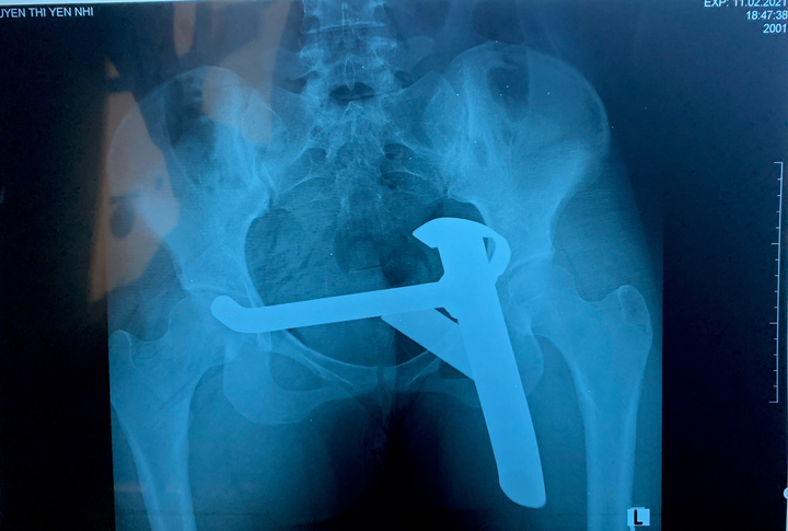 Cứu cô gái bị chân chống xe máy đâm sâu vào mông sau va chạm giao thông - 2