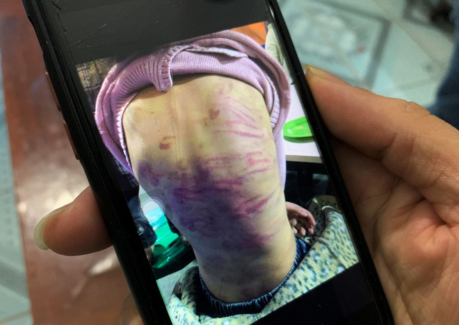 Bé gái 12 tuổi nghi bị bạo hành, xâm hại tình dục: Hà Nội chỉ đạo khẩn - 1