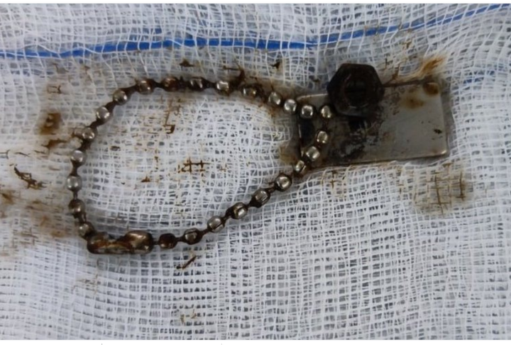 Nuốt miếng nam châm, bé trai 6 tuổi bị thủng ruột - 1