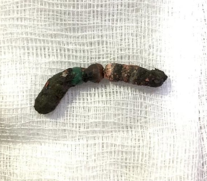 Bé gái 2 tuổi thủng ruột sau khi nuốt 7 viên bi nam châm - 1