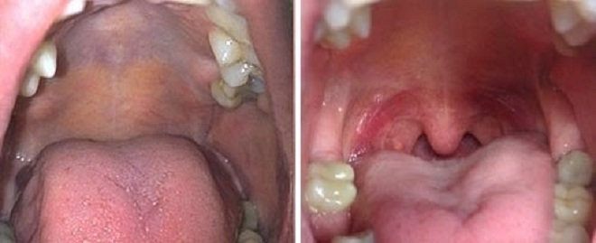 Bác sĩ Hoàng Mạnh Ninh ứng dụng công nghệ cao trong điều trị ngủ ngáy - 4