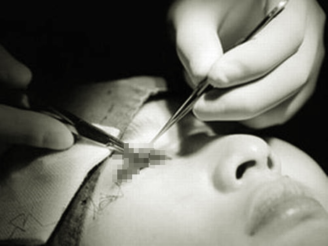 Cắt mí làm đẹp tại spa, cô gái trẻ mù một mắt, tính mạng bị đe doạ - 1