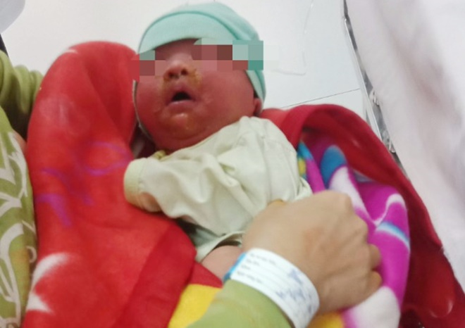 Tắm bằng nước lá cây, bé 20 ngày tuổi bị nhiễm độc nặng - 1