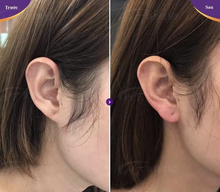 Tiêm filler vào vành tai, tài lộc chưa thấy đã phải nhập viện - 1