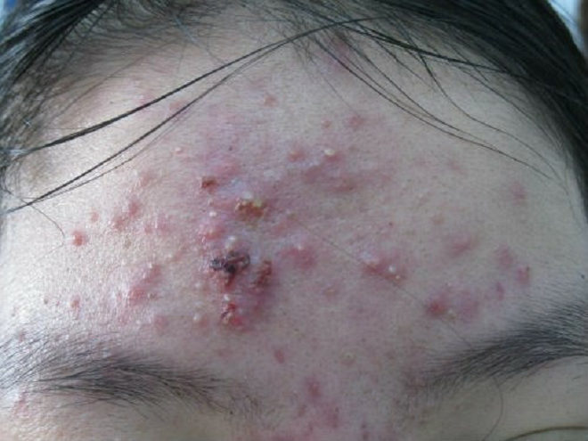 Phương pháp điều trị mụn theo phác đồ của ngành da liễu hiện nay - 1