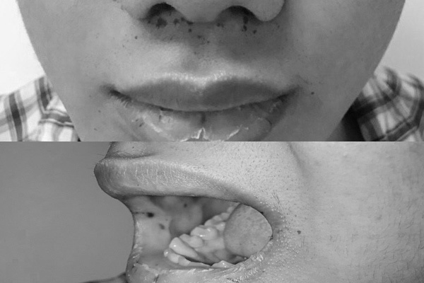 Mọc tàn nhang quanh miệng, không ngờ mắc bệnh gây hoại tử ruột - 1