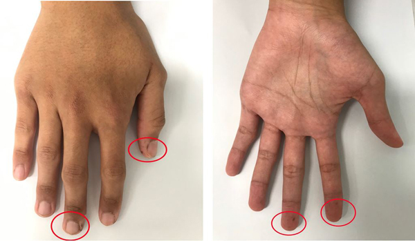 Thanh niên mọc tàn nhang quanh miệng, không ngờ mắc bệnh gây hoại tử ruột Mọc tàn nhang quanh miệng, không ngờ mắc bệnh gây hoại tử ruột - 2