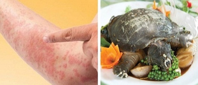 Ăn thịt ba ba, người đàn ông sốc phản vệ suýt chết - 1