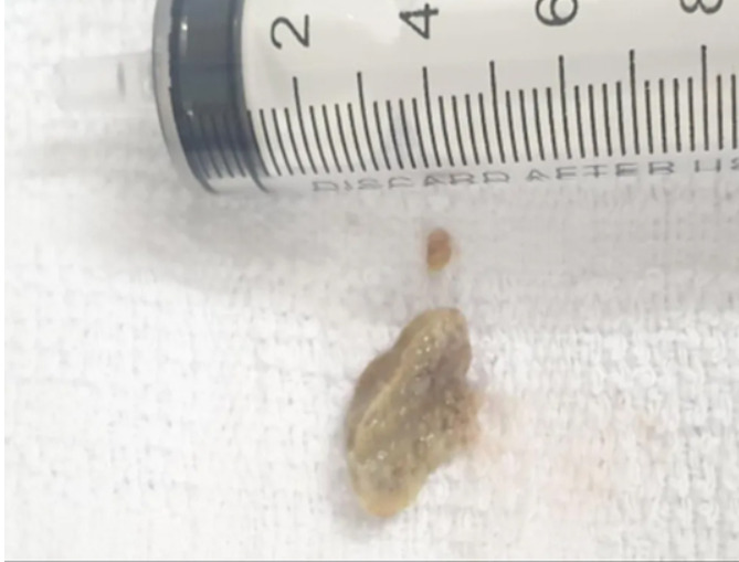 Suýt mất mạng do mảnh xương heo ở phế quản - 1