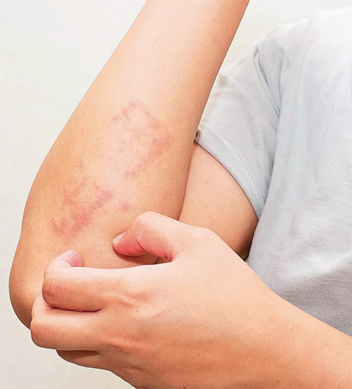 Bệnh vẩy nến làm tăng nguy cơ mắc nhiều loại ung thư - 1