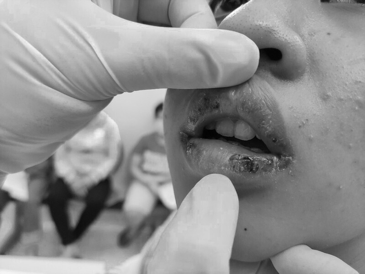 Môi thiếu nữ 15 tuổi bị mưng mủ, rỉ máu do dùng son mua trên Facebook - 1