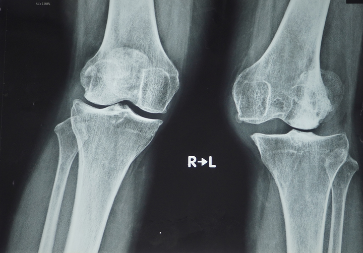 Lần đầu tại Việt Nam phẫu thuật thay khớp gối dạng bản lề bằng titanium - 1