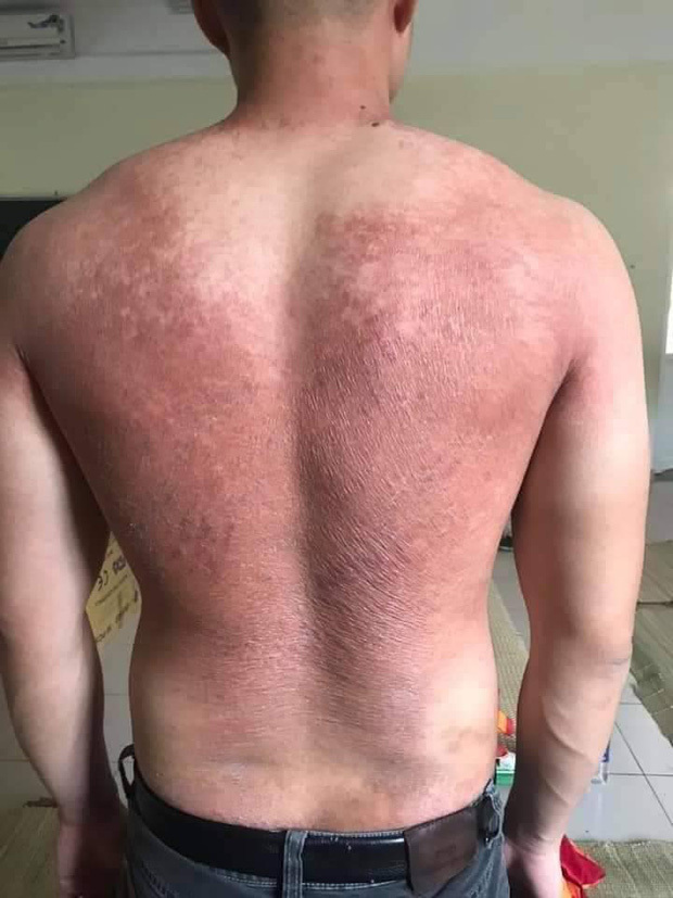 Sinh viên ở tâm dịch: Mồ hôi ướt sũng, lưng phồng rộp, trắng đêm lấy mẫu - 3