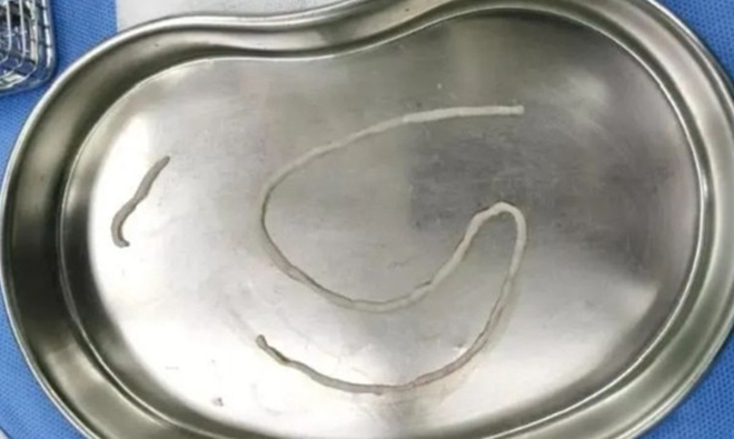 Sưng đau đi khám, phát hiện 2 con giun sống ngay trong cổ - 1