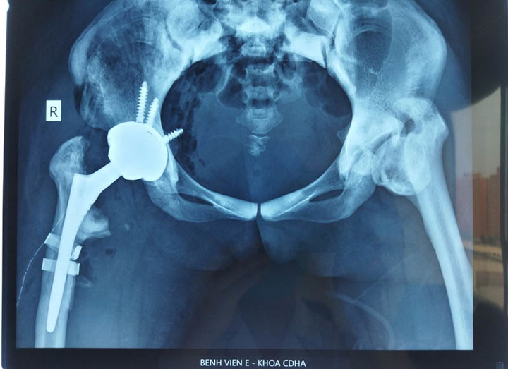 3,5 giờ cân não phẫu thuật cho bệnh nhân xương hóa đá đầu tiên ở Việt Nam - 3