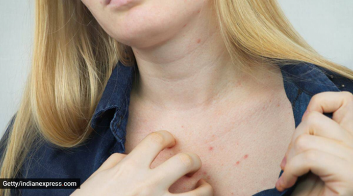 Nổi mụn ở ngực: Nguyên nhân và cách khắc phục - 1
