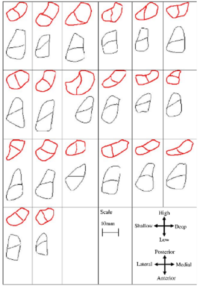 Tái tạo dây chằng chéo trước khớp gối với phương pháp 'ánh xạ giải phẫu' - 1