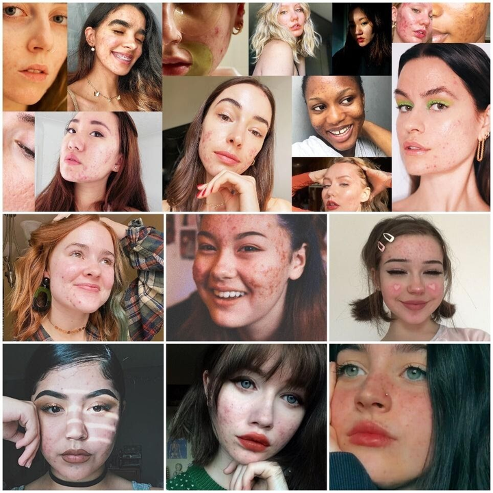 Suy nghĩ tích cực về mụn, vượt qua sự tự ti để yêu thương chính mình - 1