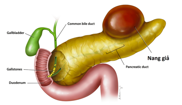 8 dấu hiệu cảnh báo bệnh viêm tụy cấp: Rất nguy hiểm nên bạn cần đi khám ngay - 3