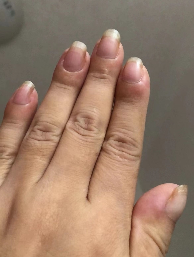 Ngón tay sưng to, cô gái điếng người khi biết mình bị ung thư phổi - 1