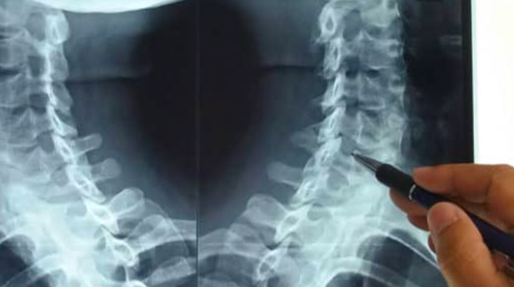Bệnh thoái hóa đốt sống cổ 'tấn công' cả người trẻ: 4 việc nên làm để ngăn chặn - 2