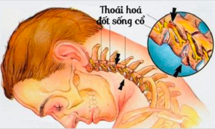 Bệnh thoái hóa đốt sống cổ 'tấn công' cả người trẻ: 4 việc nên làm để ngăn chặn - 3