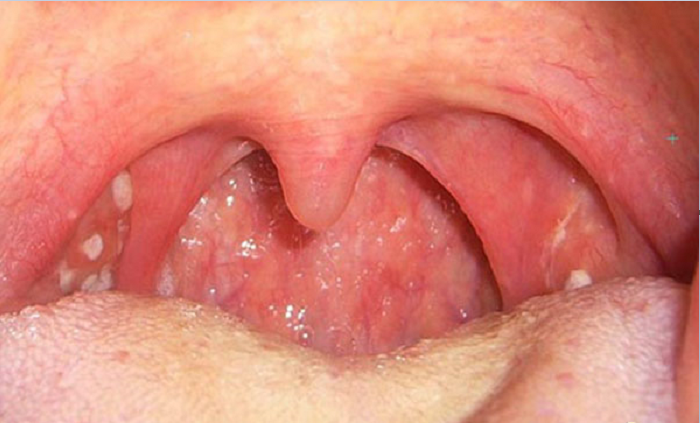 Dấu hiệu cảnh báo sớm của 13 bệnh ung thư phổ biến nhất: Nắm rõ để bảo vệ mình - 4