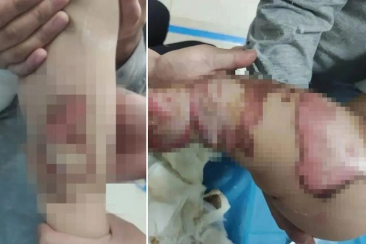 'Tè' dầm khi đắp chăn điện, bé trai 1 tuổi bị bỏng nặng - 1